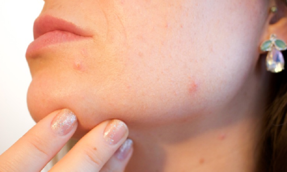 Acne Treatment. Essential Things To Know I Coolherbals